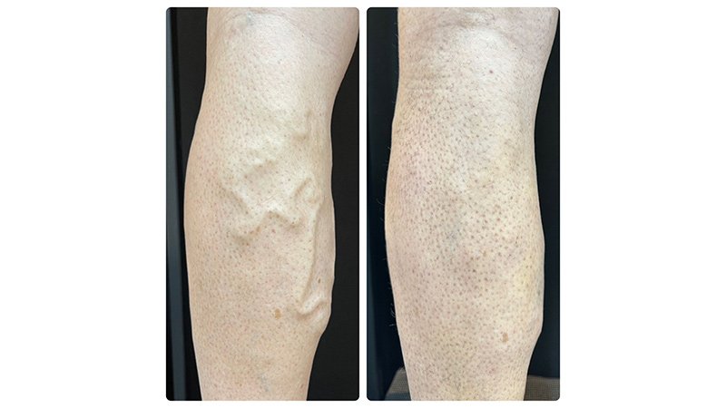Resultado vascular con EVLT