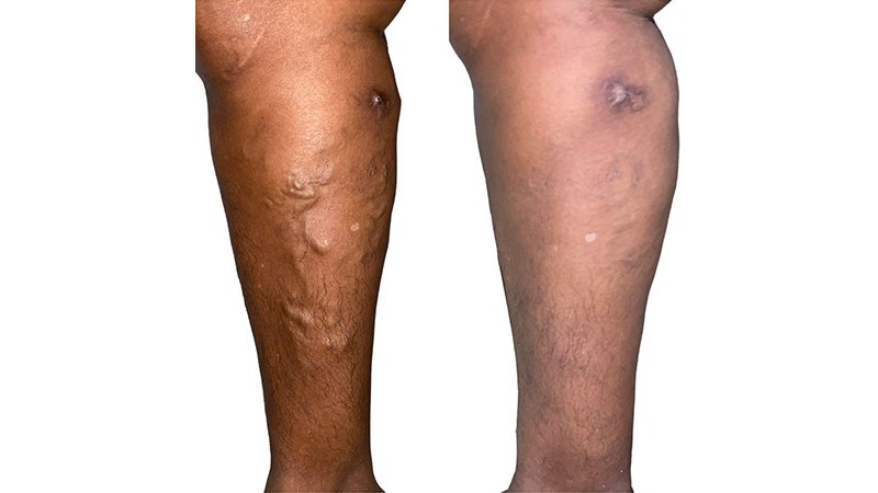 Tratamiento vascular de pierna