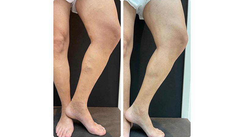 Caso vascular antes y después